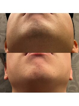 フェリーバ(FELIVA)/お髭が薄い方も脱毛しております