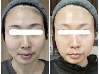 アップライン(Up Line)/エクソソームの施術前/施術後