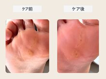 ルポ 伊勢/ウオノメケア