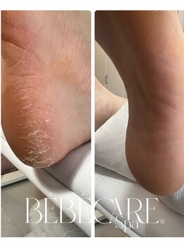 ラウレア(Laulea)/角質コース¥8800