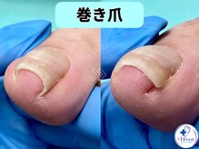 プラスワンフット 本厚木(+1 Foot)/筋トレで踏ん張ると痛む巻き爪