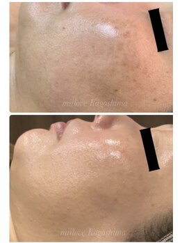 ミーラブ 鹿児島(miilove)/シミ改善・ハリ艶ＵＰ