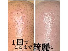 ラディア(Radia)の雰囲気（毛穴エクストラクション/長年蓄積の頑固な黒ずみ毛穴解決/￥9000）