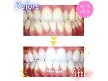 エクシアホワイトニング 奥田店の雰囲気（エクシア会員様の継続中before after）