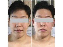 ペリー(PELLY)/矯正と美容液導入