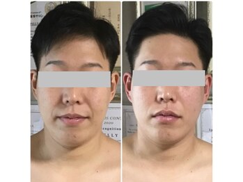 ペリー(PELLY)/矯正と美容液導入