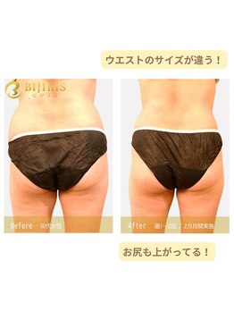 キングスサロン 熊本/美尻イスでウエスト変化