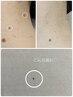 【新常識のシミケア】ピンポイント照射でかさぶた化→自然にポロリ♪全顏30分