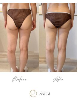 プラウド(Proud)/EMS引き締め/下半身/お尻