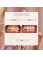 プラスビー 2号店(+b)/ホワイトニングビフォーアフター