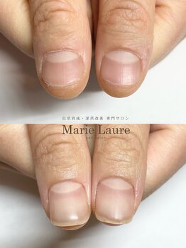 マリーロール 梅田店(Marie Laure)/自爪育成/深爪矯正/ネイルケア
