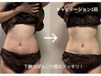 サロン メグル(SALON MEGURU)/痩身60分 一回の施術