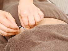 こくぶんじ北口鍼灸院/鍼（はり）