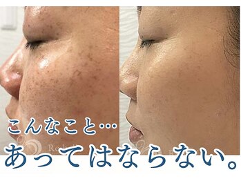 パルファンカルム 駅西本町店/大人気のハーブピーリング!