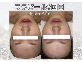 ハウピア(Haupia)/韓国で人気の施術ララピール