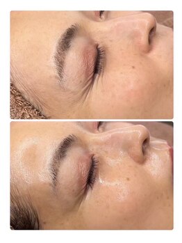 ホリシア 博多(HORISHIA)/ララピール/毛穴/ニキビケア