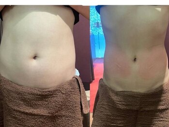 コスメ デ グレース(cosme de greace)/脂肪冷却を数回施術