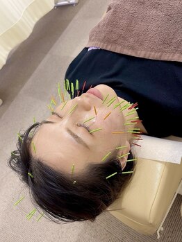 ながれかわ整骨院の写真/【初回限定★美容鍼＋小顔マッサージ￥5,400→￥4,400】シミ・しわ改善をし若々しい見た目に♪