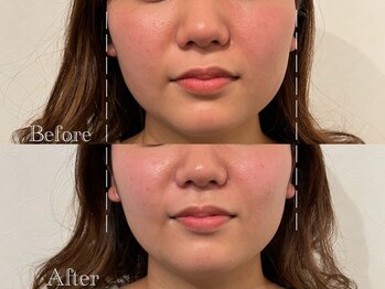 エクボ 立川店(EKUBO)/頬幅すっきり!小顔効果◎