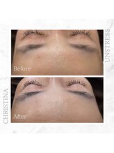 シャルムパリス(charme paris)/額美人♪１回の施術変化