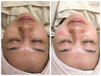 マヴィ 香里園店(MavY.)/ノンニードル水光注入