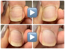 爪のいろは/巻き爪ケア