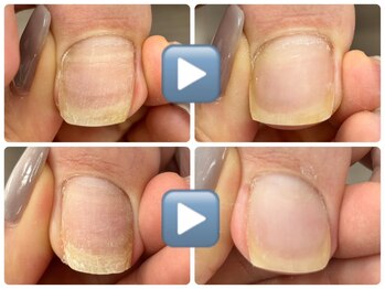 爪のいろは/巻き爪ケア