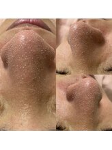 エルフ(elf)/当店一番人気！韓国式3D毛穴洗浄