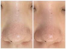 ホワイトアクア 岐阜店(WHITE AQUA)/ハーブピーリング/岐阜