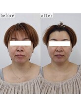 ヴェルシック(Belchic)/頬の厚みがここまでスッキリ