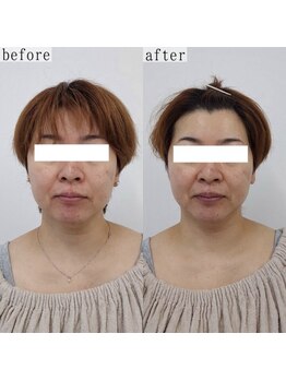 ヴェルシック(Belchic)/頬の厚みがここまでスッキリ