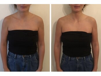 ミチカケ トリムリターン那覇市店/もっこり肩サヨナラ！