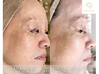 サロンドレナ 名駅店/ハーブピーリング サロンドレナ