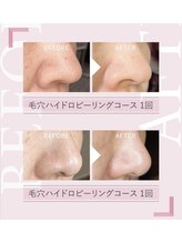 エステサロン アンジュール(Angelle)/ハイドロピーリング