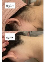 アミティエ 高田馬場店(Amitie)/【施術症例】うなじ脱毛