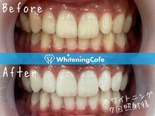 ホワイトニングカフェ 松本店(WhiteningCafe)/ホワイトニングビフォーアフター