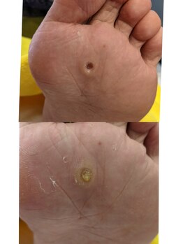 ズキーンとする魚の目