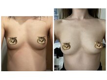 ワイサロン(Y salon)/20代/産後バストアップ/5ヶ月