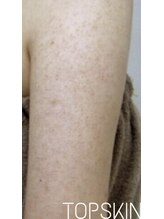 トップスキン 表参道(TOPSKIN)/二の腕のブツブツ/ざらつき改善