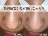 8月限定★毛穴詰まり黒ずみ撃退◎SNSで話題の毛穴エクストラクション《全顔》