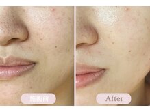 エピル(EPIL)/DEEPクリアスキン毛穴洗浄症例