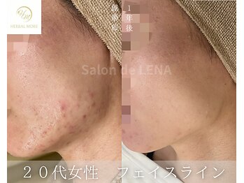 サロンドレナ 名駅店/ハーブピーリング サロンドレナ