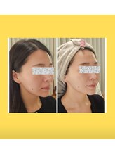 アン 銀座(ann)/レモンボトル１回目