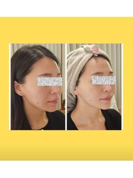 アン 銀座(ann)/レモンボトル1回目