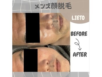 リエート(LIETO)/【毎日の髭剃りにさよなら】