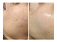 高濃度ハーブピーリング【FCRトリートメント】が八尾で出来る！