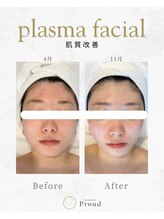 プラウド(Proud)/プラズマ（アミノ酸導入）事例