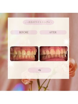 プラスビー 2号店(+b)/ホワイトニングビフォーアフター