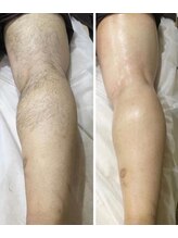 ジョアアンジェ 京橋店(joie ange)/ハーフパンツも海もツルツルで♪