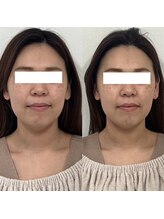 ヴェルシック(Belchic)/むくみ・たるみ悩みまとめて改善